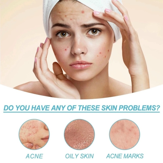 Крем от прыщей 23030094